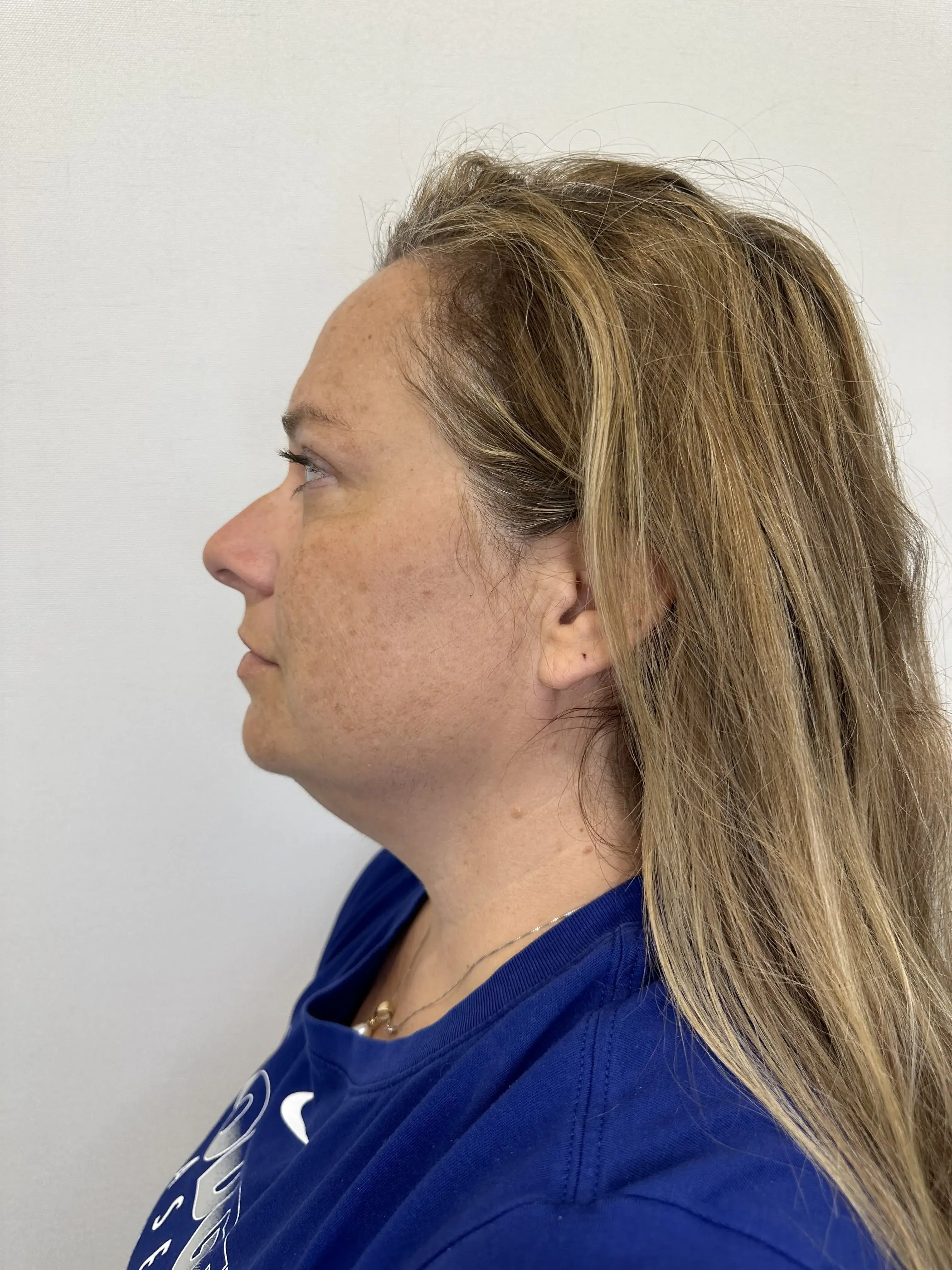 Before treatment — client 4