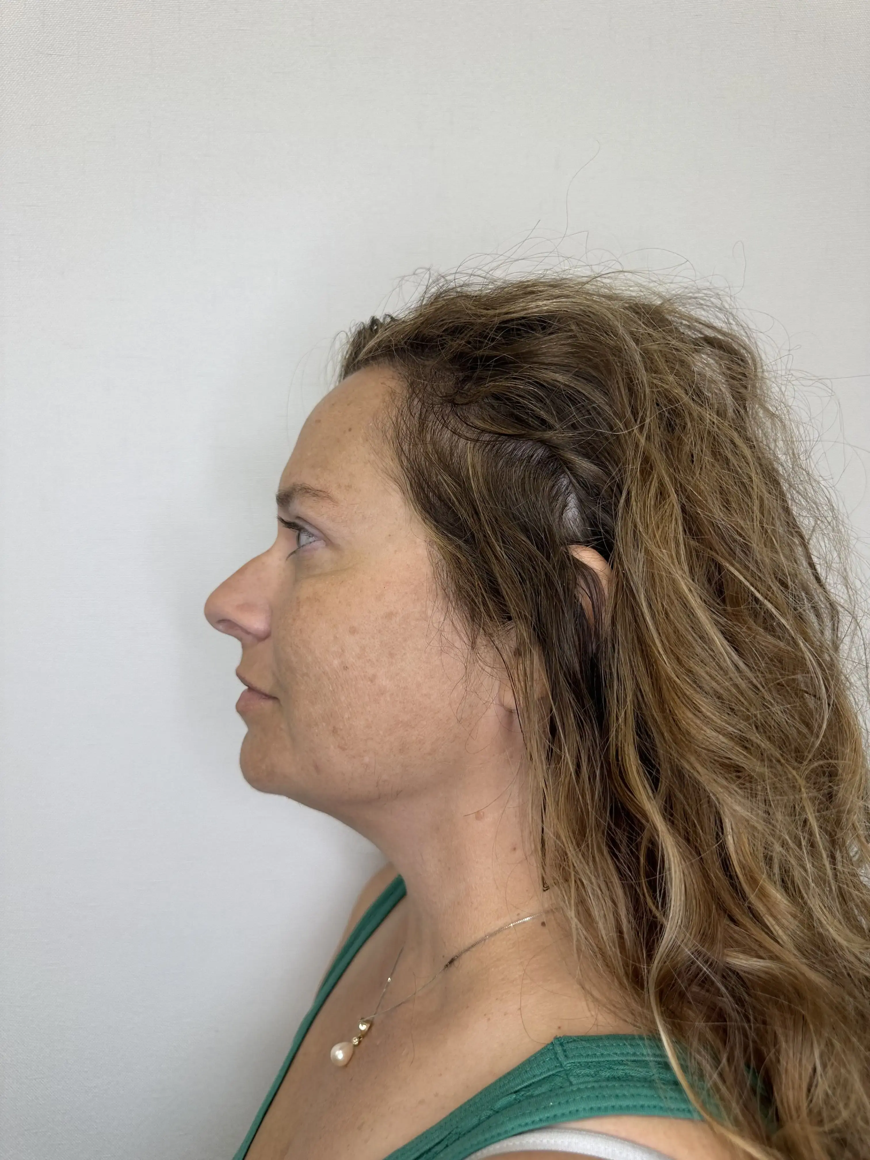 After treatment — client 4
